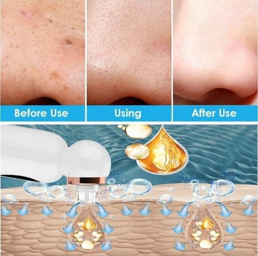 جهاز شفط الرؤوس السوداء الذكي لتنظيف البشرة – Smart Blackhead Remover Facial Device