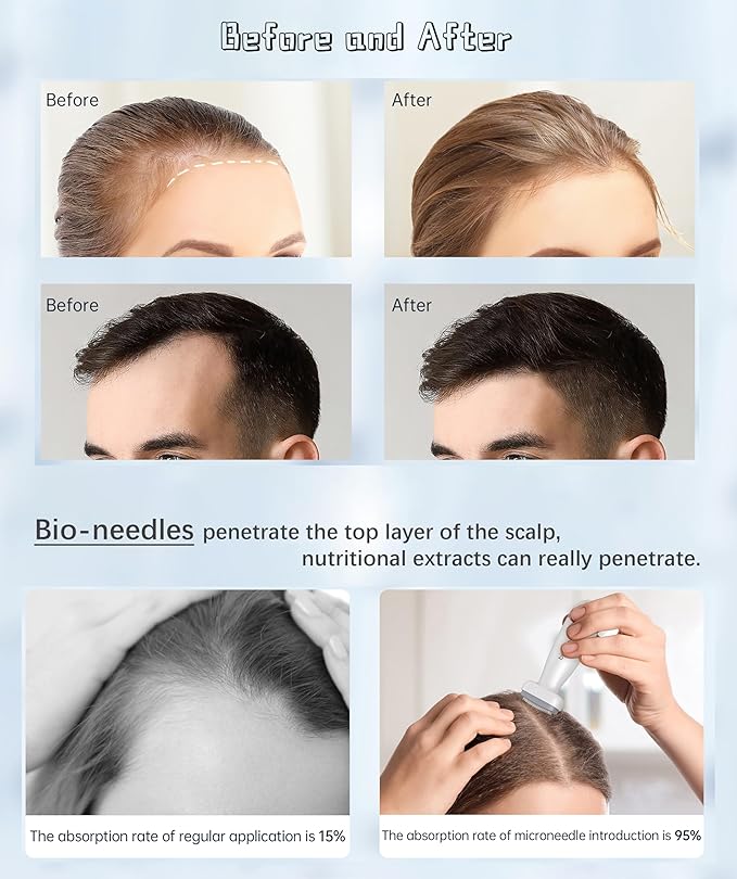 جهاز ديرما ستامب Bioneedle بإبر دقيقة قابلة للتعديل للعناية بالبشرة وتحفيز نمو الشعر – Bioneedle Adjustable Microneedling Derma Stamp for Skin Care & Hair Growth (120 Needles)