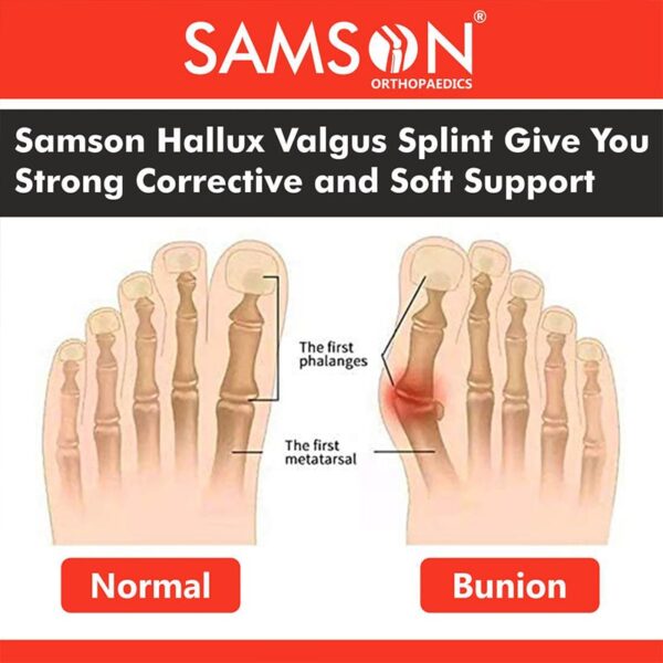 HALLUX VALGUS SPLINT ( SAMSON ) - Qasr Elteb