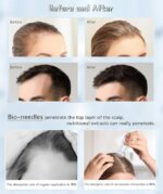 جهاز ديرما ستامب Bioneedle بإبر دقيقة قابلة للتعديل للعناية بالبشرة وتحفيز نمو الشعر – Bioneedle Adjustable Microneedling Derma Stamp for Skin Care & Hair Growth (120 Needles) - Image 7